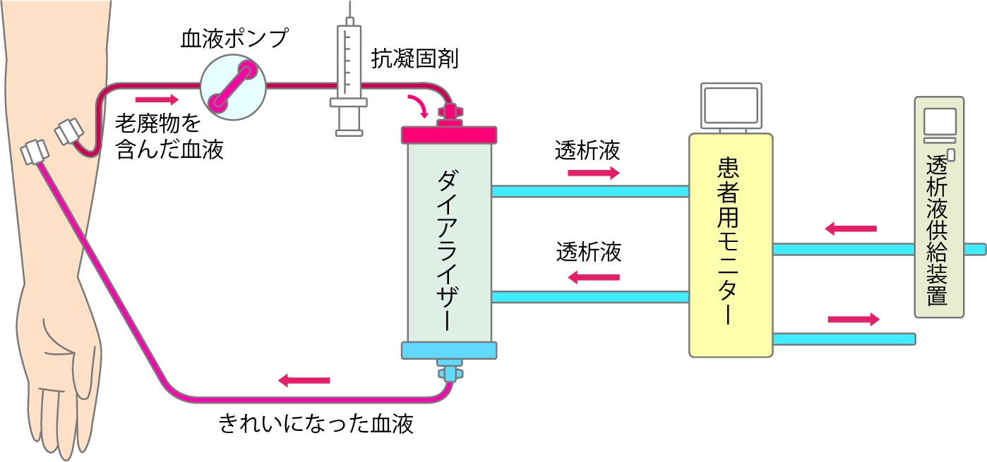 人工透析の流れ図