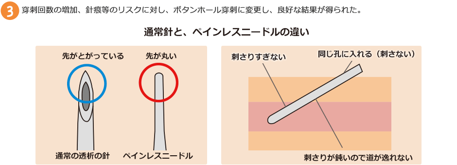穿刺回数の増加、針痕等のリスクに対し、ボタンホール穿刺に変更し、良好な結果が得られた。